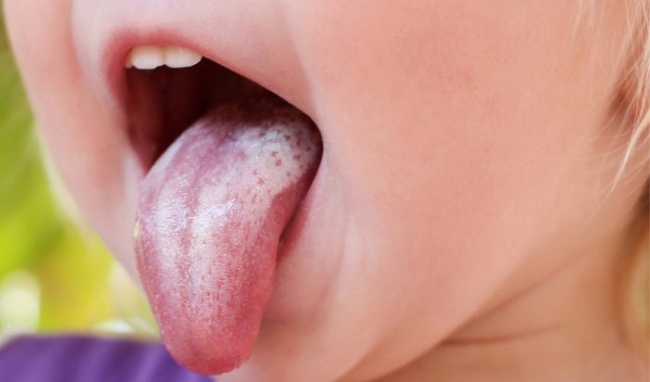 Dấu hiệu mắc bệnh nấm lưỡi và cách điều trị