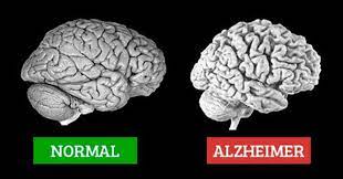 Bệnh Alzheimer’s là gì?